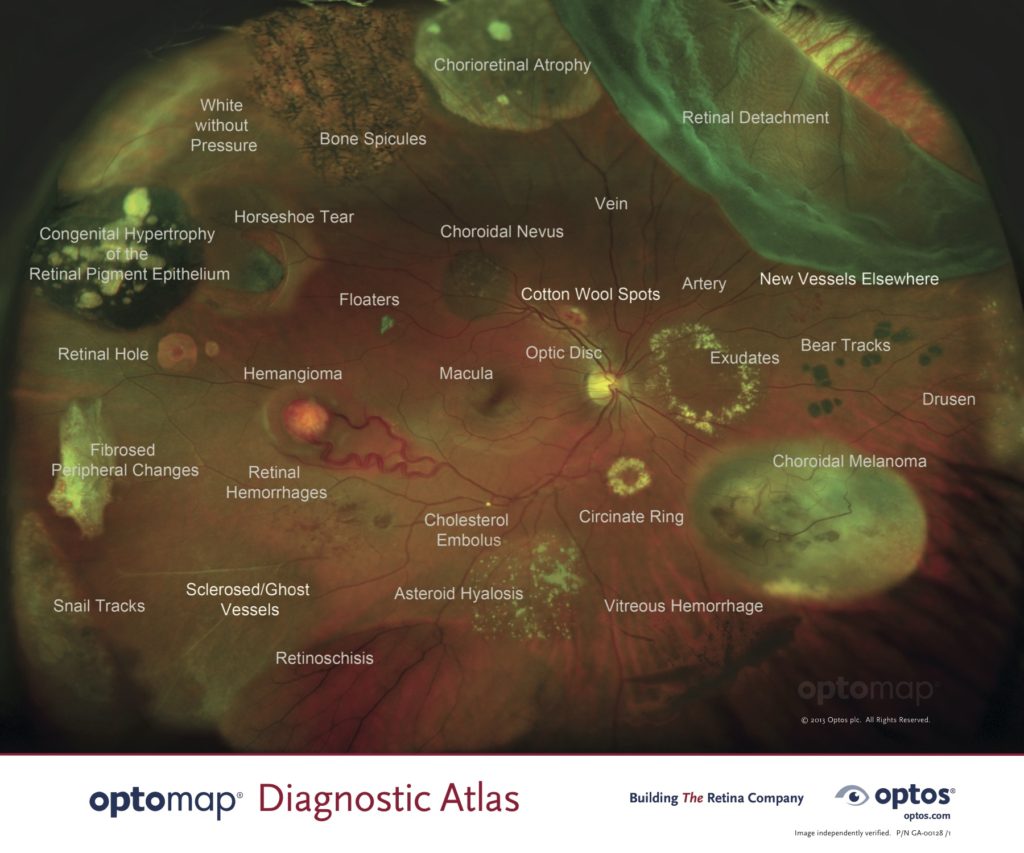 Bear Tracks Retina